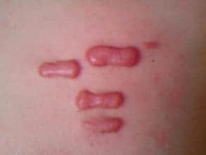 疤痕病种 疤痕疙瘩  长在胸部的疤痕疙瘩表现为一种不规则的肥厚性增
