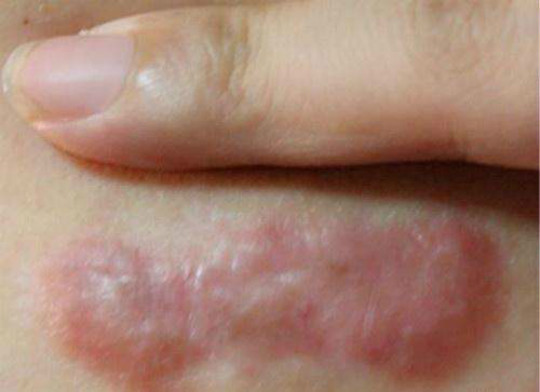 来源:昆明昆大疤痕医院